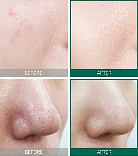 Some By Mi 30 Days Miracle Toner